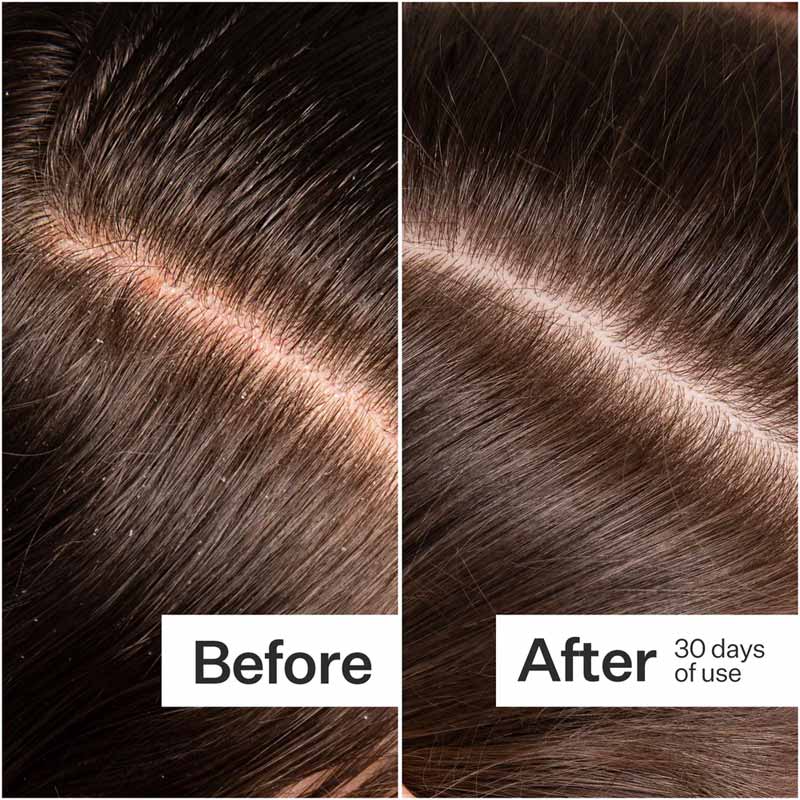 Act+Acre Microbiome Cooling Scalp Serum | Instant relief | Dry, itchy scalp | Reduces dandruff flakes