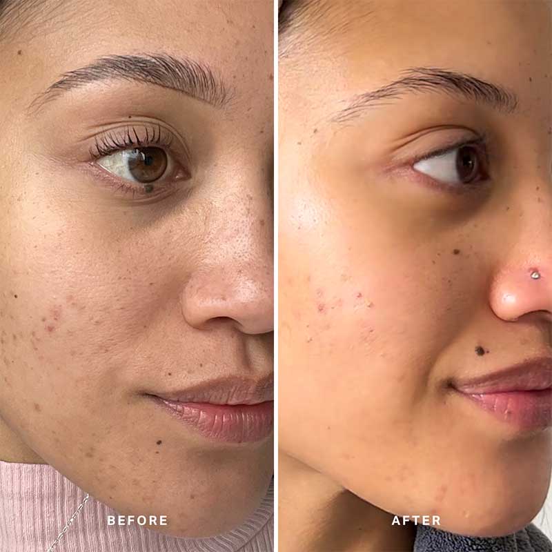 Alpha-H | Liquid Gold Exfoliating Treatment With 5% Glycolic Acid | Vitamin B Serum With 5% Niacinamide | before & after