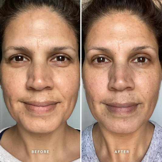 Alpha-H | Vitamin B Serum With 5% Niacinamide | before & after