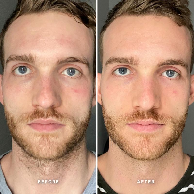 Alpha-H | Vitamin B Serum With 5% Niacinamide | before & after
