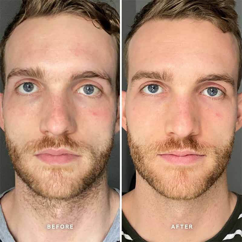Alpha-H Vitamin B Serum with 5% Niacinamide | man before and after using vitamin b niacinamide