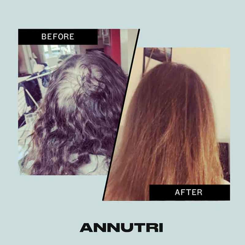 Annutri Grow It Hair supplement Before & After, hair thinning and loss, hair supplement that works
