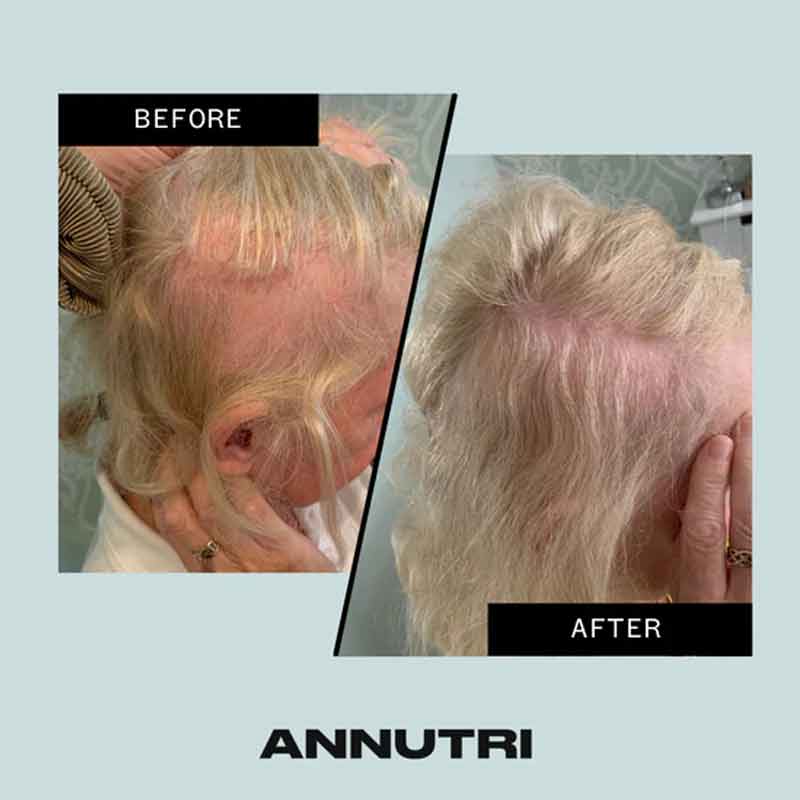 Annutri Hair Loss Supplement, Grow it Hair Growth Supplement, solutions for thinning hair