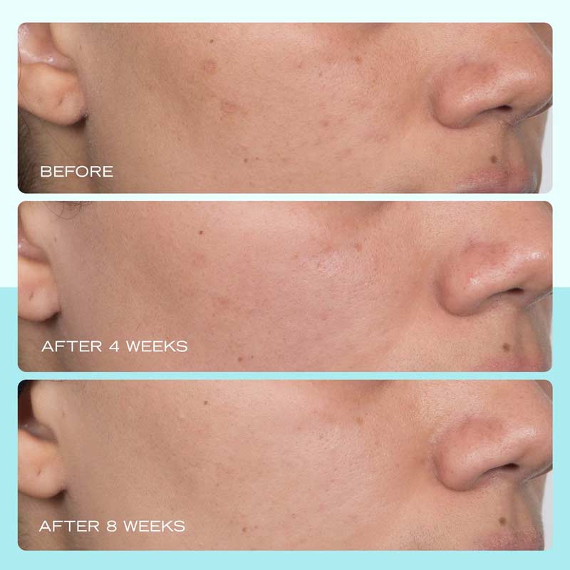 First Aid Beauty | Dark Spot Serum | Niacinamide | hydrating serum | targets dark spots | reduces sunspots | reduces hyperpigmentation | reduces discolouration | reduces post-acne marks | brighter skin tone | even skin tone | gentle formula | improves skin tone | smooth skin | healthy-looking skin