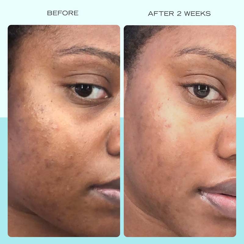 First Aid Beauty | Dark Spot Serum | Niacinamide | hydrating serum | targets dark spots | reduces sunspots | reduces hyperpigmentation | reduces discolouration | reduces post-acne marks | brighter skin tone | even skin tone | gentle formula | improves skin tone | smooth skin | healthy-looking skin
