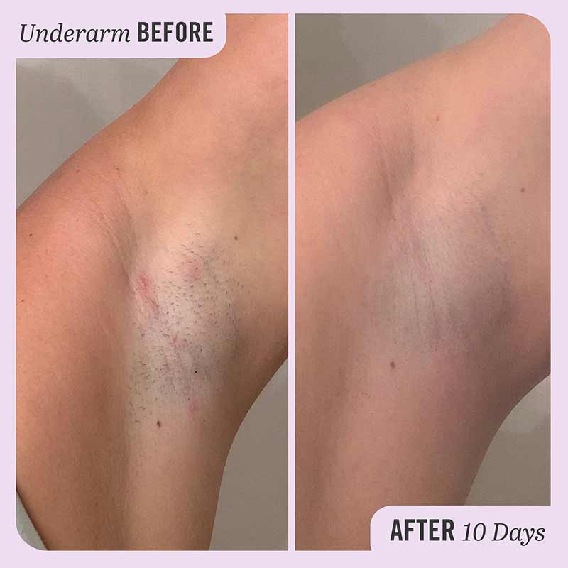 First Aid Beauty Ingrown Hair Pads | how to get rid of razor burn bumps ingrown hairs