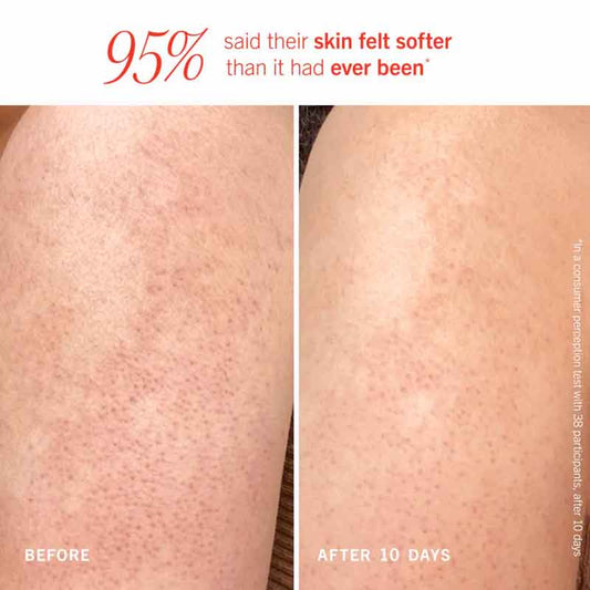 First Aid Beauty KP Bump Eraser Body with 10% AHA Before & After 10 days