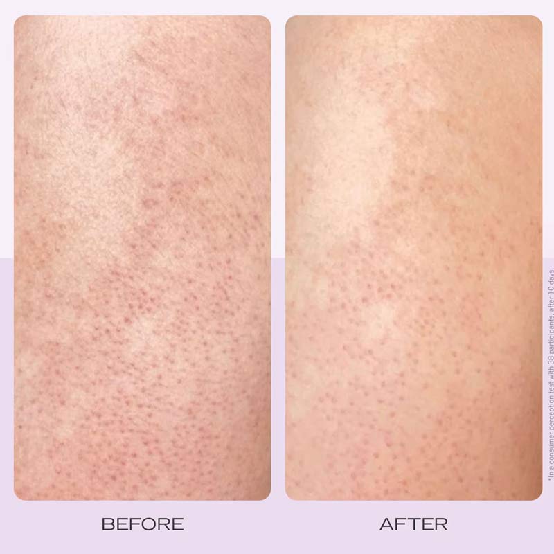 First Aid Beauty Soft + Smooth Starter Kit Results Before And After