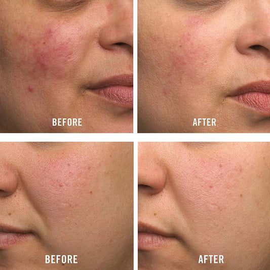 First Aid Beauty Ultra Repair Cream | before and after