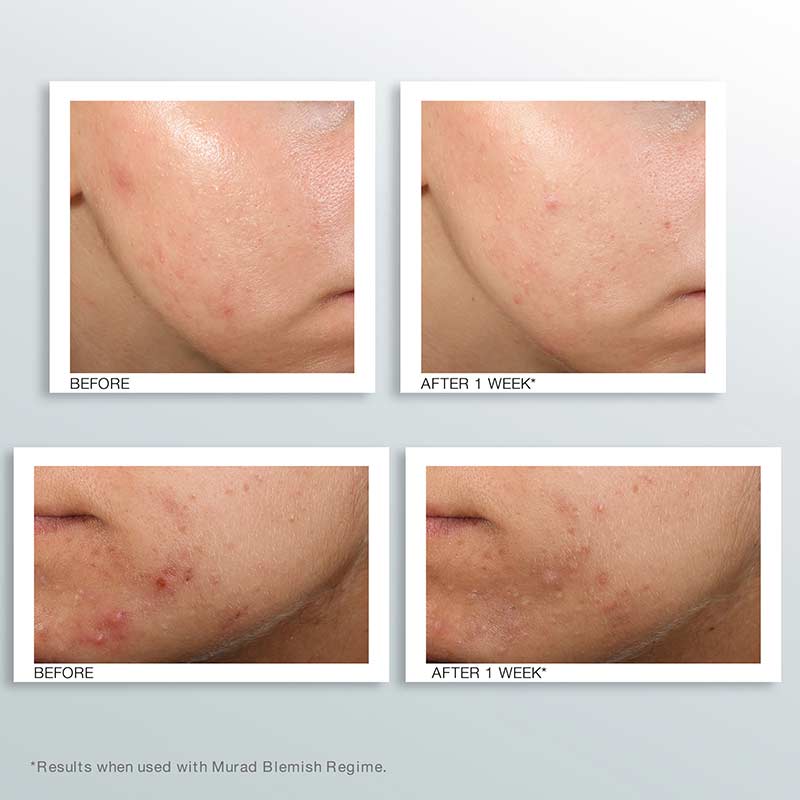 Murad Blemish Control Outsmart Blemish Clarifying Treatment | reduce blemishes | blackheads