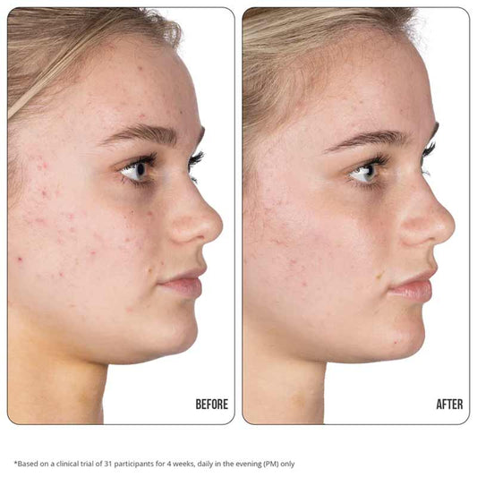 Nip + Fab Retinol Fix Blemish Gel Treatment 10% for targetting spots, acne, blemishes and dark marks | Retinol balances and evens out the skin with strong anti aging properties