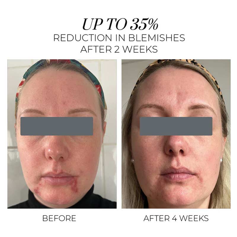 Oskia London | Violet Water Clearing Cleanser Blemish Control Facial Cleansing Gel | Blemishes | Acne Scarring | Acne | Clear Skin Cleanser