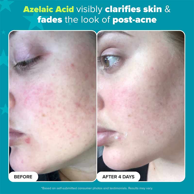 Paula's Choice Azelaic Acid Before and after picture