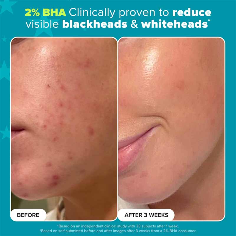 Paula's Choice 2% BHA Before and After