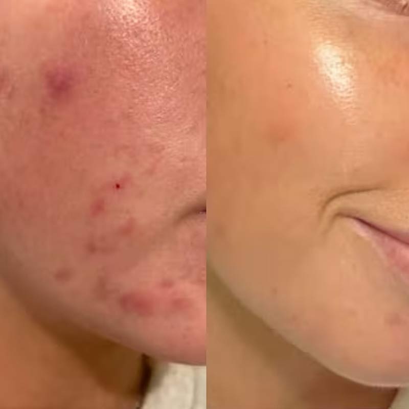 Results from using Paula's Choice Skin Perfecting 2% BHA Liquid Exfoliant