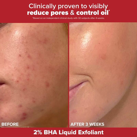 Skincare Giftset, Gifts for Her, 2% BHA Liquid Exfoliant