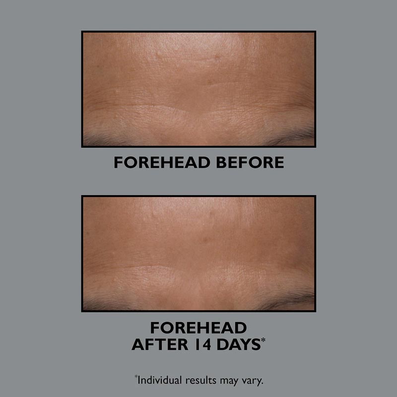 Peter Thomas Roth, Peter Thomas Roth FIRMx Collagen Moisturizer, Forehead Wrinkles, Forehead Lines