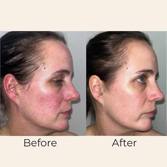 Skin Formulas, Skin Formulas Hydra Hyaluronic Acid Serum Before & After, hydrating face serum, pigmentation