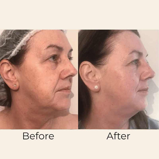 Skin Formulas, Skin Formulas Mask Exfoliator 2IN1 Formulabefore & after, exfoliating face mask