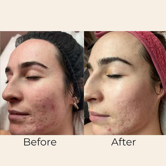 Skin Formulas, Skin Formulas Vit A Vitamin A Restore Serum Before & After, serum for acne, acne scarring