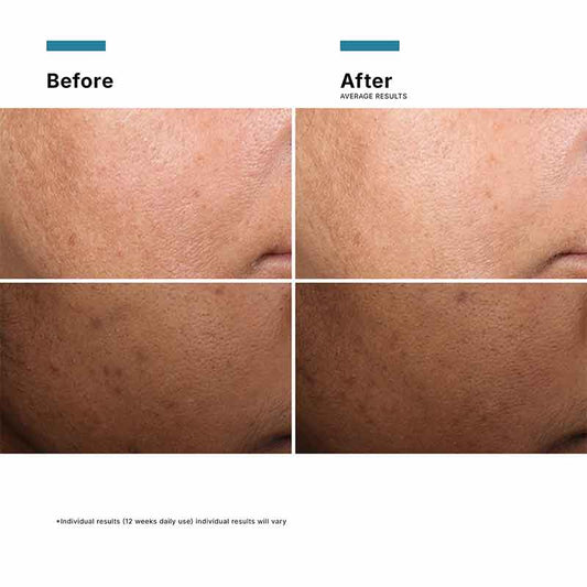 SkinCeuticals Discoloration Defense Serum Before & After