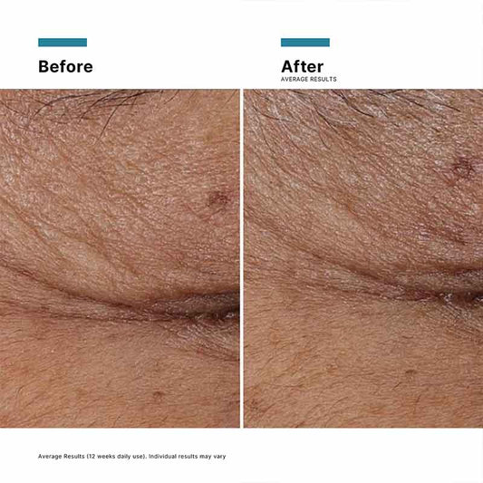 SkinCeuticals P-TIOX Wrinkle Modulating Peptide Serum Before & After