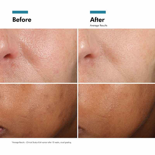 SkinCeuticals Phloretin CF Serum Before & After