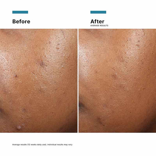 SkinCeuticals Phyto A+ Brightening Treatment Moisturiser Before & After