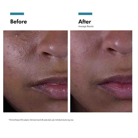 SkinCeuticals Silymarin CF Serum For Blemish Prone Skin Before & after