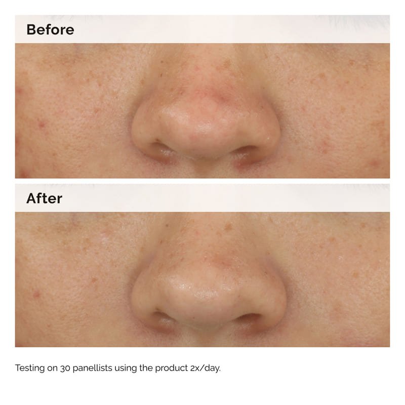 The Ordinary | Balancing & Clarifying Serum | Clogged Pores | Hyperpigmentation | Textured Skin
