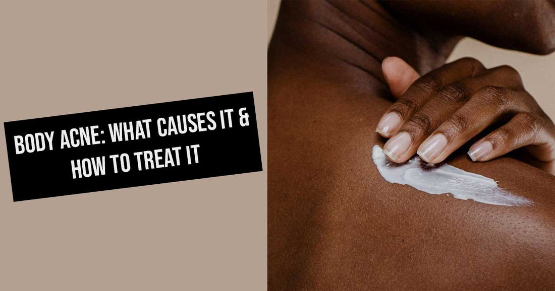 Body Acne: What Causes It & How To Treat It