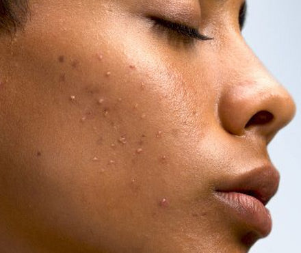 Acne & Blemishes