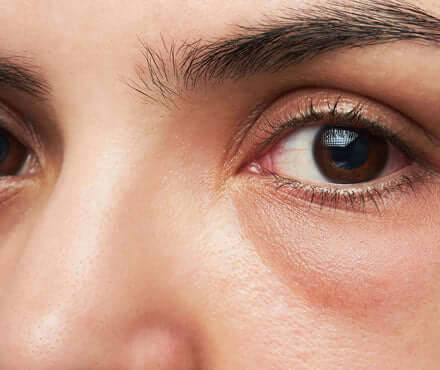 Dark Circles & Puffiness - Cloud 10 Beauty