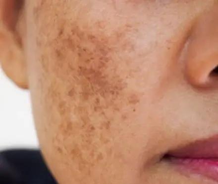 Pigmentation - Cloud 10 Beauty
