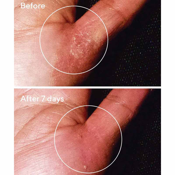 Murad Quick Relief Moisture Treatment | fast-acting | therapeutic cream | works | instantly soothe skin | relieves itching | redness | rashes | discomfort | eczema | sensitive skin | dermatitis | skin conditions | quick | relief