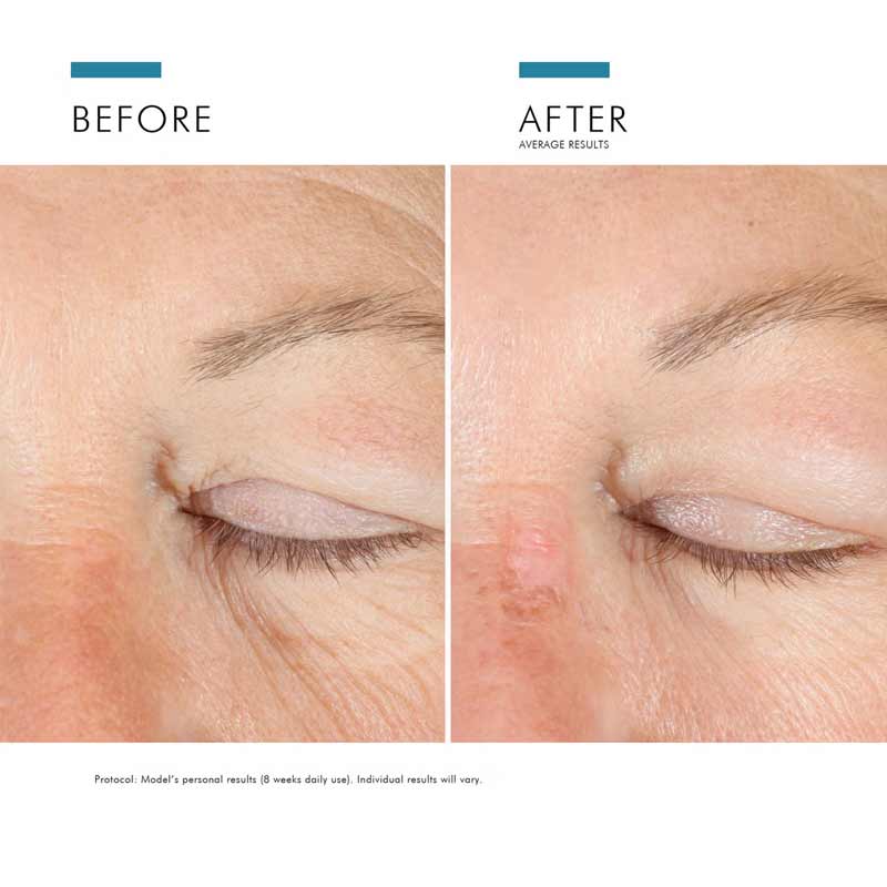 SkinCeuticals A.G.E. Advanced Eye For Dark Circles Results Before & After