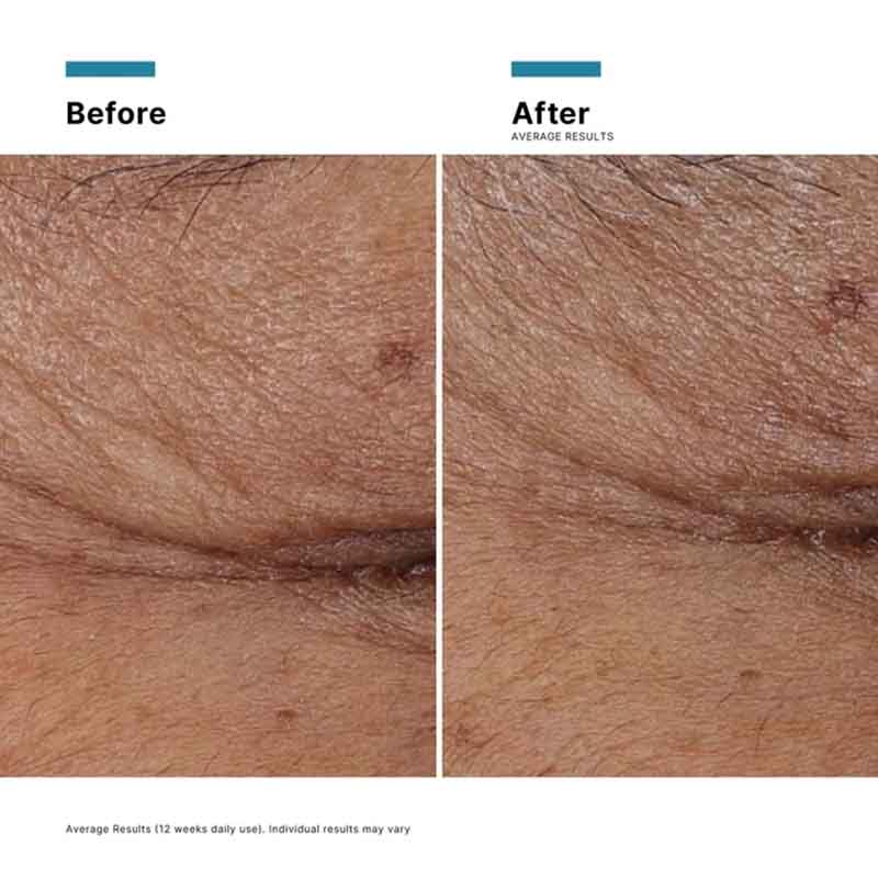 Before and after comparison close-ups of a horizontal facial wrinkle on skin, with the left panel labeled 'Before' and the right panel labeled 'After' on a white background.