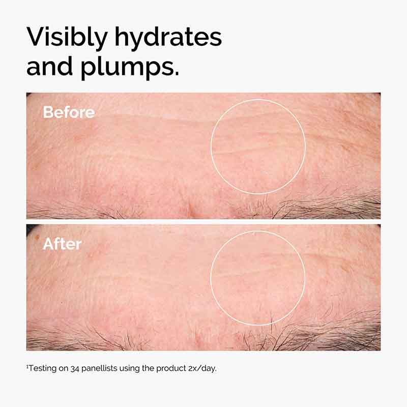 The Ordinary The Renewal Gift Set Before & After forehead wrinkles