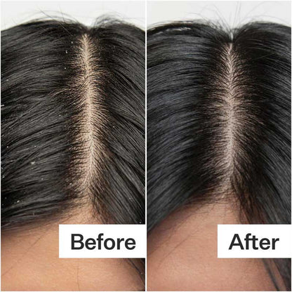 Act+Acre Dry + Itchy Scalp System
