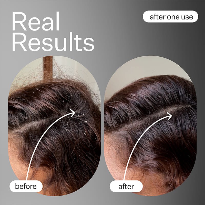 Act+Acre Cold Processed Scalp Detox | #1 Best Seller | Award-Winning Scalp Detox Treatment | lightweight pre-cleanse oil | Basil Leaf, Baobab Oil, Moringa Oil | healthier scalp | luscious locks.