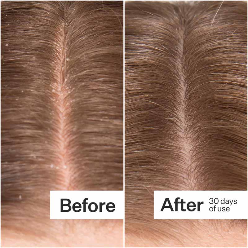Act+Acre Microbiome Cooling Scalp Serum | Before & After | results 