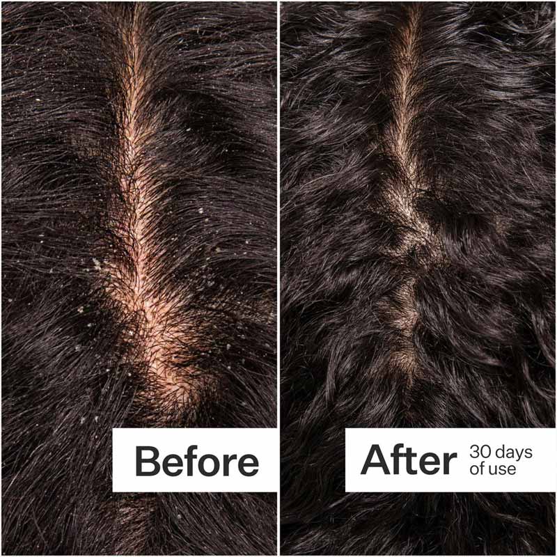 Act+Acre Microbiome Cooling Scalp Serum | All hair types and textures | scalp care 