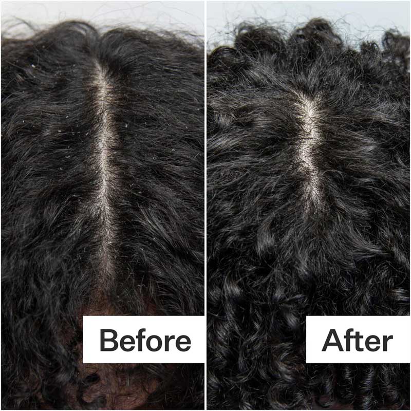Act+Acre Scalp Build-Up System | Scalp Detox & Stem Cell Scalp Serum | Breaks down excess sebum & product residue | Promotes healthy, full-looking hair | Creates optimal environment for hair growth