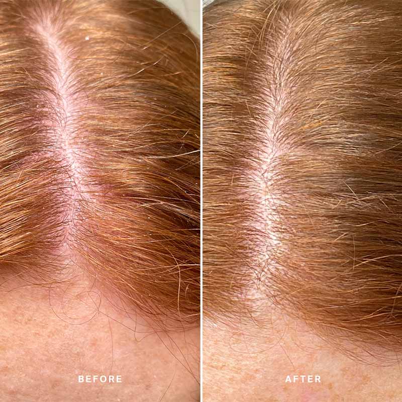 Alpha-H Healthy Scalp Exfoliating Treatment | Australian Desert Lime  | Results in just one minute