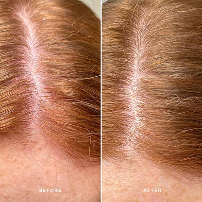 Alpha-H Healthy Scalp Exfoliating Treatment | Australian Desert Lime  | Results in just one minute