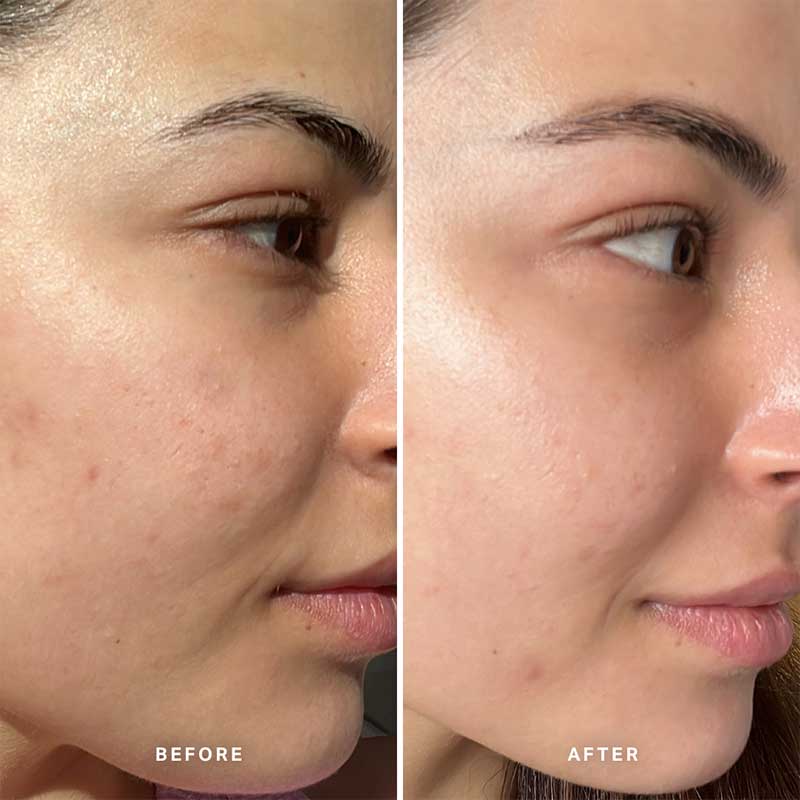 Alpha-H Liquid Gold Exfoliating Treatment With 5% Glycolic Acid, exfoliating facial toner