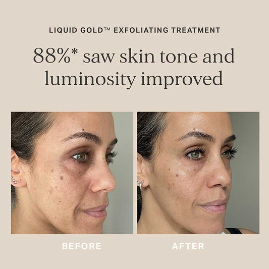 Alpha-H Liquid Gold + FREE Alpha-H Liquid Gold with Vitamin C, dull skin, uneven skin tone, skincare for skin texture