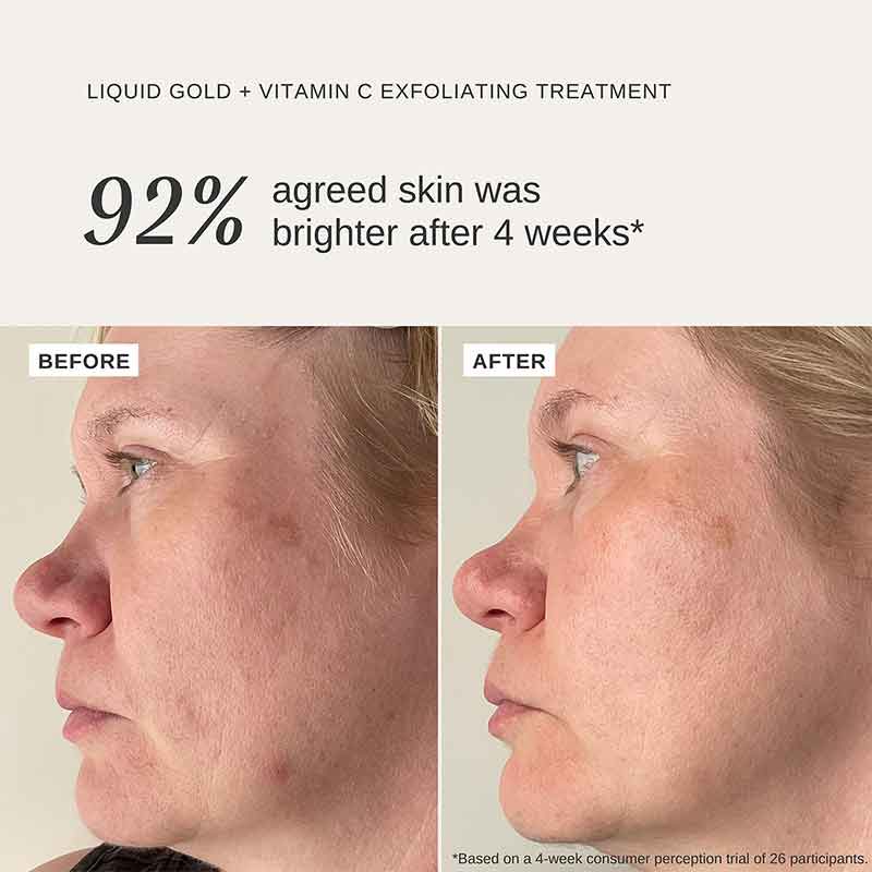 Alpha-H, Alpha-H Liquid Gold Exfoliating Treatment with vitamin C, collagen boost