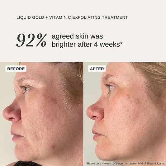 Alpha-H, Alpha-H Liquid Gold Exfoliating Treatment with vitamin C, collagen boost