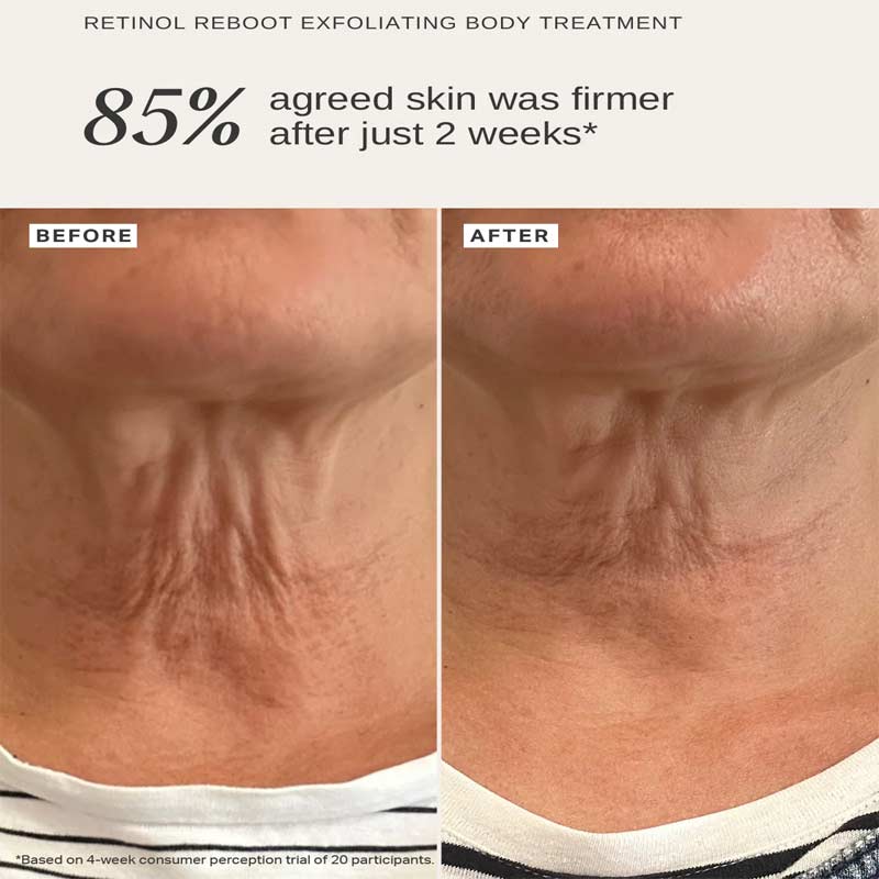Alpha-H, Retinol Reboot Exfoliating Body Treatment, before & after, firm neck, wrinkles, skin sagging